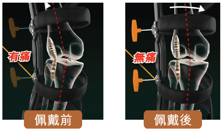 Brace comparison